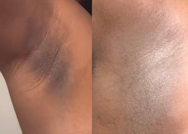 Body hyperpigmentation bundle